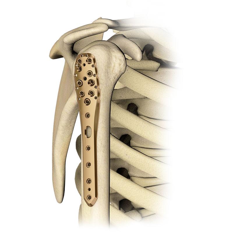 Пластина для проксимального відділу плечової кістки ложкоподібна 5.0ChLP
